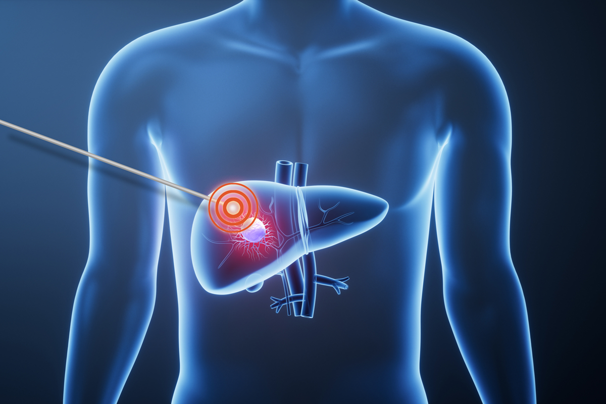 cancertoday heatkillscancer